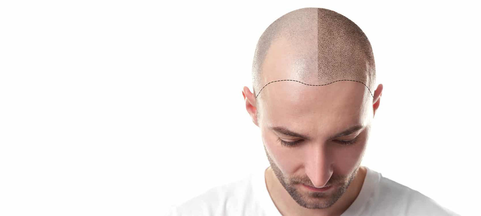 Hair Transplantation Services